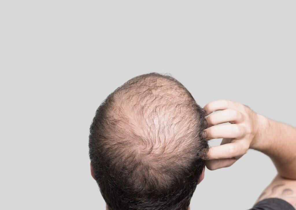 Losing Your Hair Worrying About Baldness