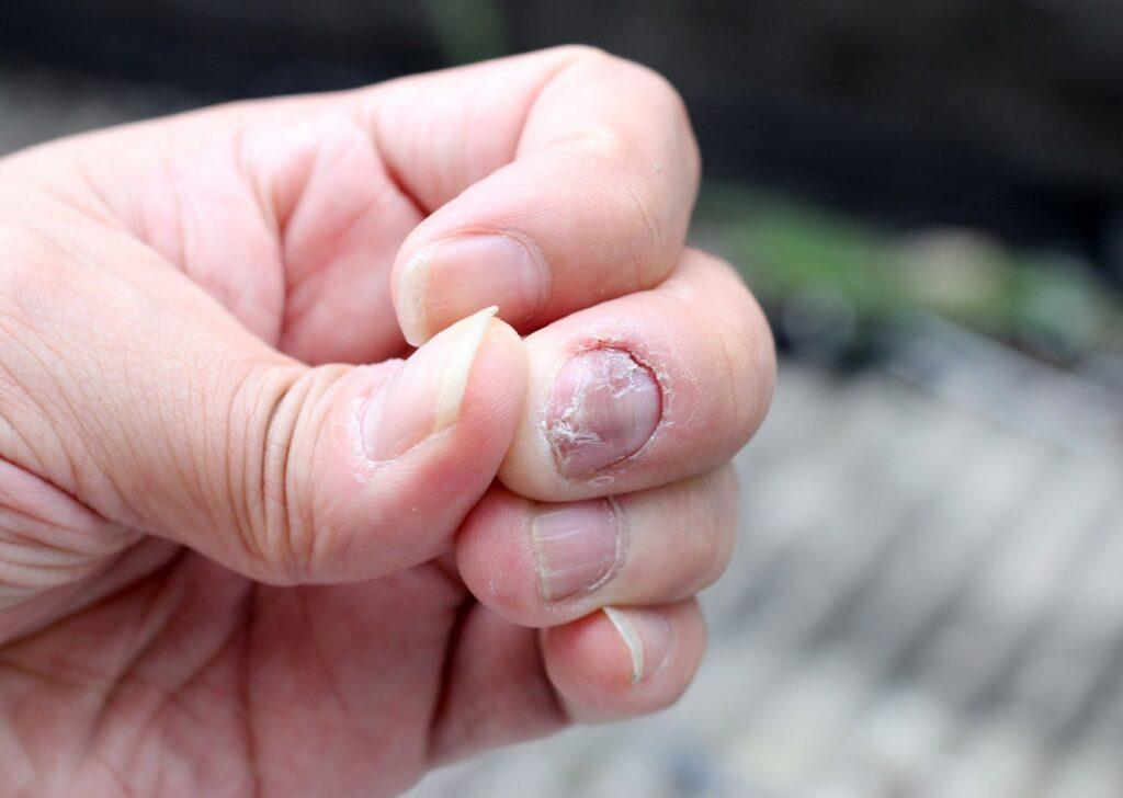 Nail Fungus Can Be Painful